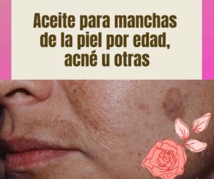 Lee más sobre el artículo Aceite totalmente natural para las manchas de la piel, ya sean manchas por la edad, el sol o acné.