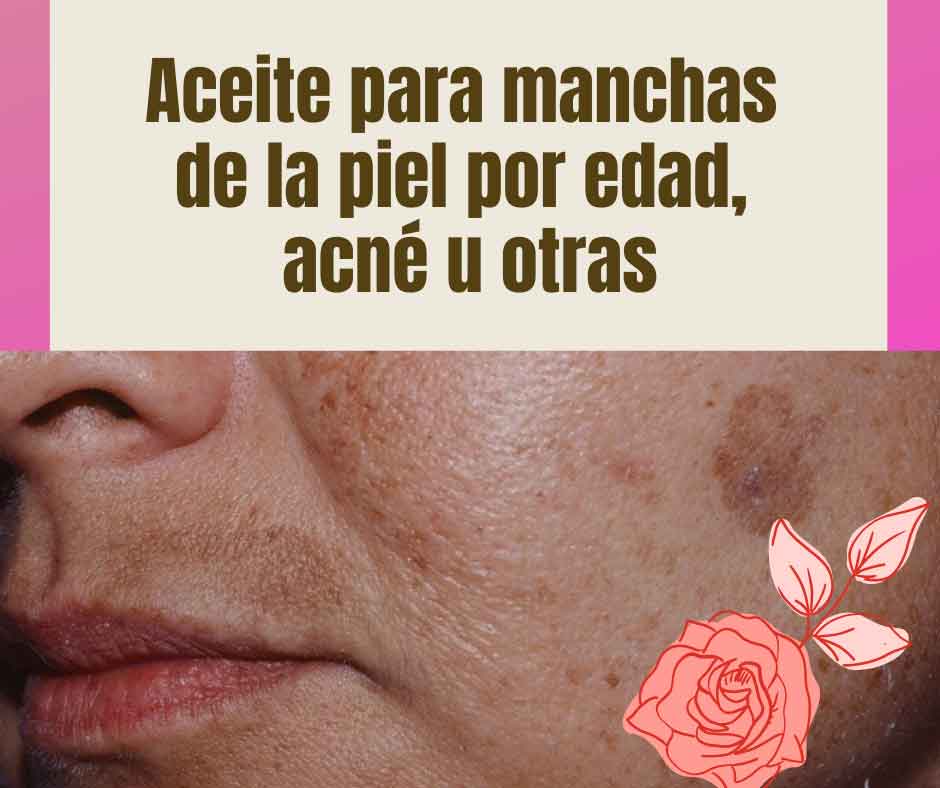 En este momento estás viendo Aceite totalmente natural para las manchas de la piel, ya sean manchas por la edad, el sol o acné.