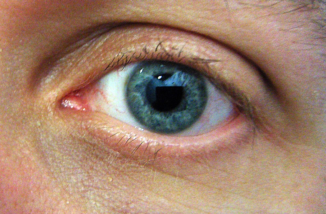 En este momento estás viendo Remedio para ojeras y bolsas de los ojos.