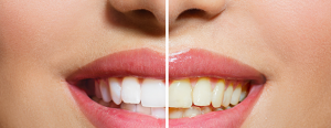 Lee más sobre el artículo Remedios caseros para blanquear los dientes