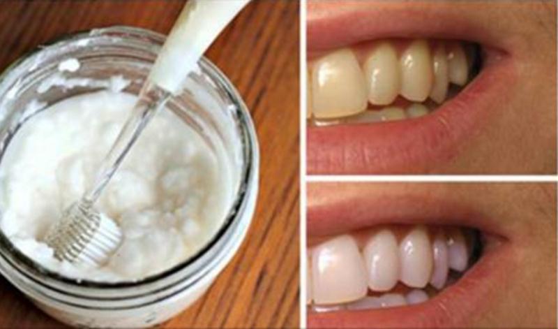 En este momento estás viendo 6 Remedios que blanquean tus dientes de forma natural