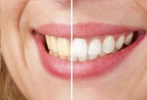 Lee más sobre el artículo Cómo eliminar el sarro de los dientes naturalmente