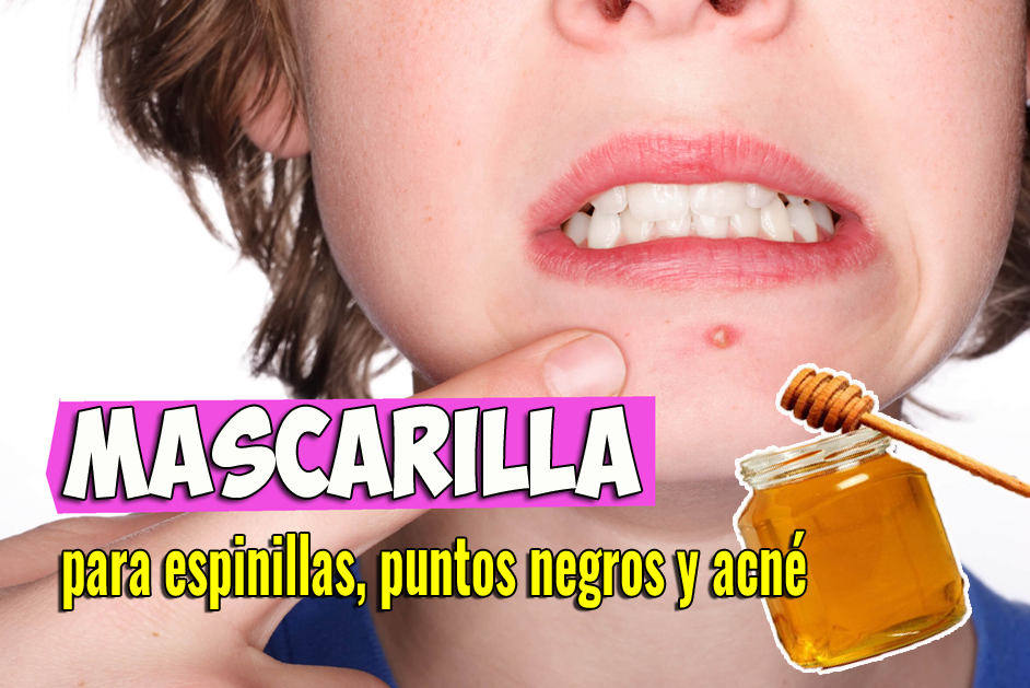 En este momento estás viendo Mascarilla para espinillas, puntos negros