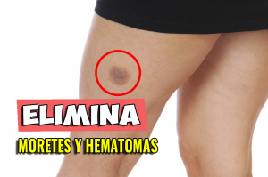 Lee más sobre el artículo Remedio efectivo para golpes, hematomas, y picaduras de insecto inflamadas