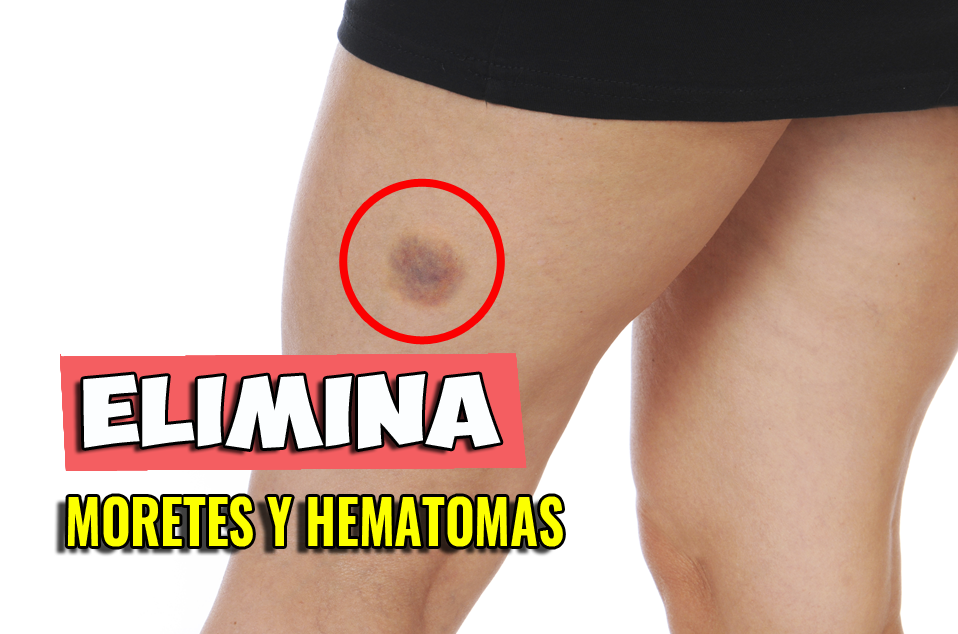 En este momento estás viendo Remedio efectivo para golpes, hematomas, y picaduras de insecto inflamadas