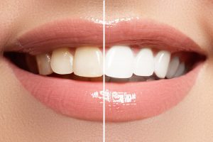 Lee más sobre el artículo 9 alimentos que pueden dañar el esmalte de tus dientes